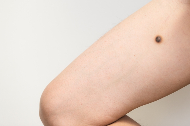 ほくろ・いぼとは？