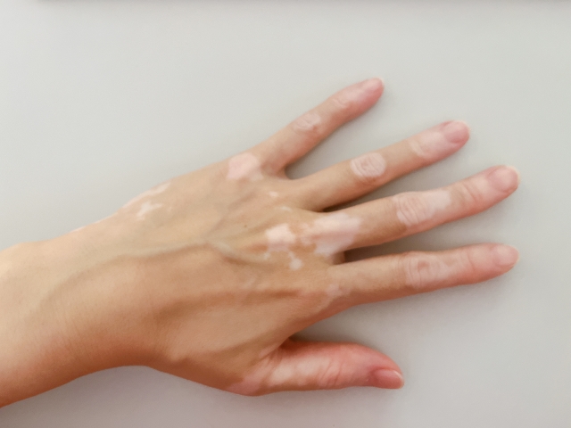 白斑（尋常性白斑）とは